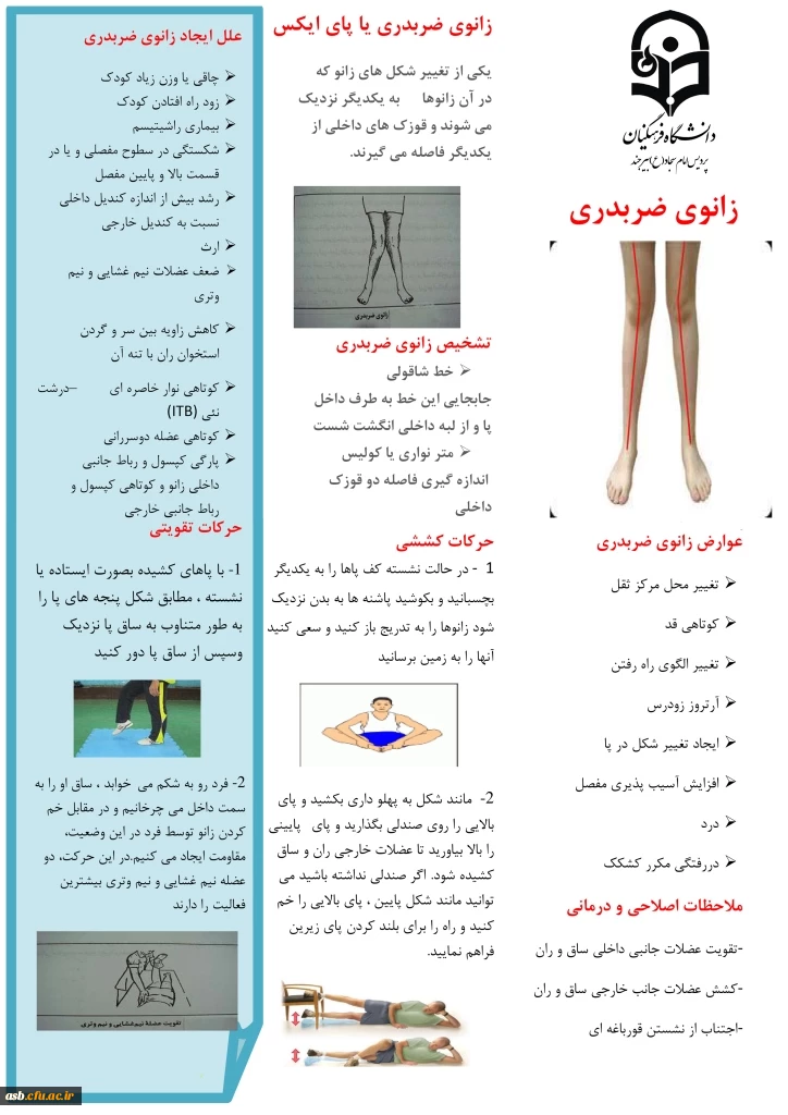 زانوی ضریدری یا پای ایکس