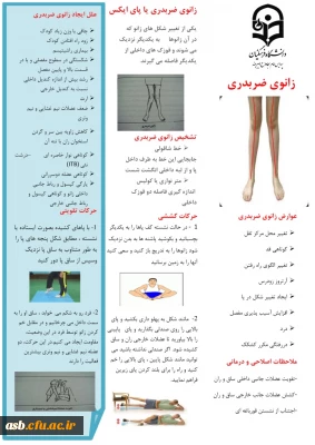 زانوی ضربدری یا پای ایکس